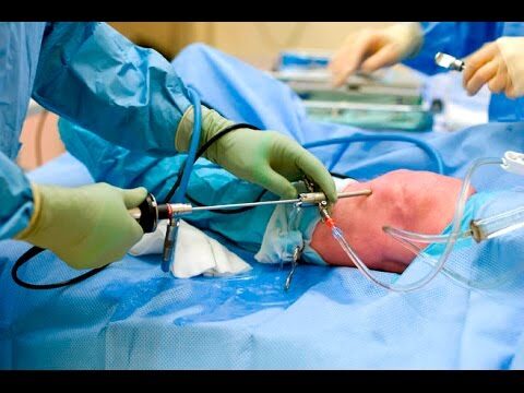 Tempo de Cirurgia em Artroscopia de Joelho: O Que Esperar