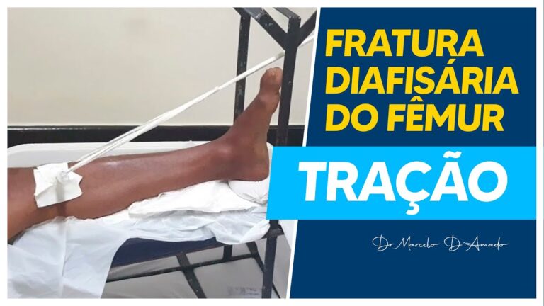 Ferros na Perna: Causas, Sintomas e Tratamentos Eficazes