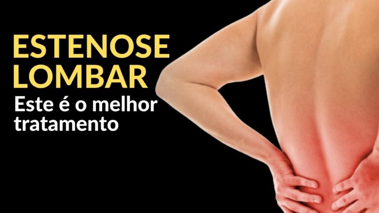 Tratamento Eficaz com Medicamento para Estenose Lombar