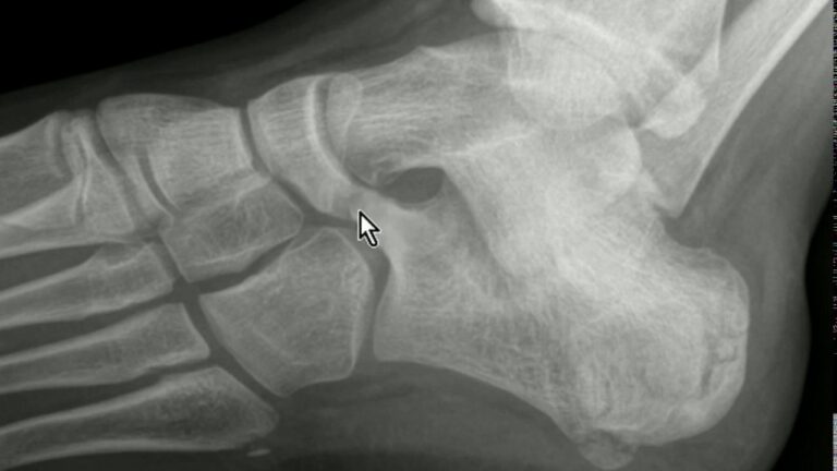 Recuperação Eficiente Após Cirurgia de Coalizão Tarsal