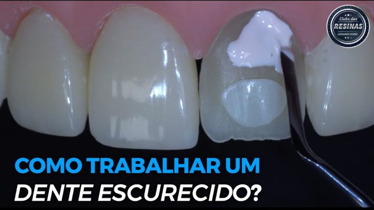 Dente Cinza: Causas e Soluções