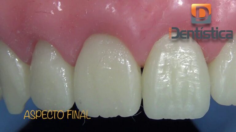 Vantagens da Coroa Total Acrílica na Odontologia