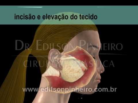 Transforma&ccedil;&otilde;es do Lifting Facial: Antes e Depois