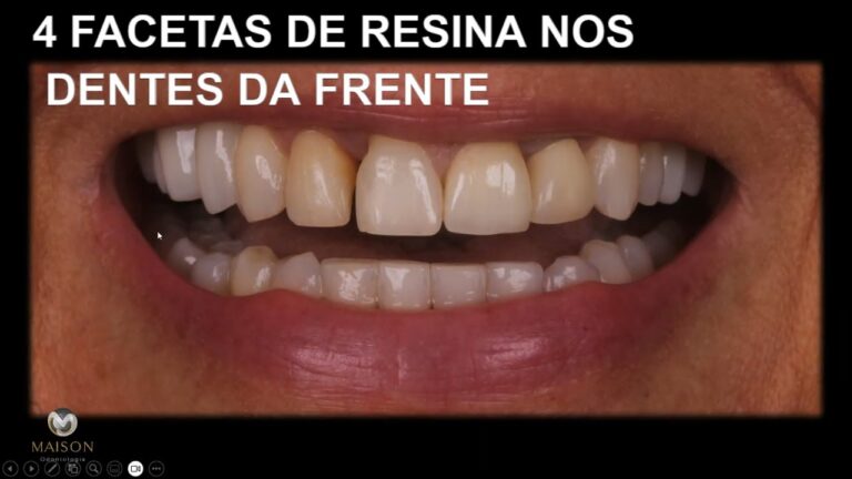 Explorando a Faceta Odontológica: Estética e Função