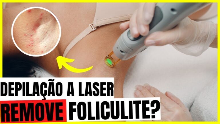 Como Evitar Foliculite Após Depilação a Laser