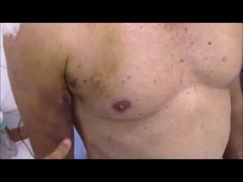 O Custo da Cirurgia de Ombro para Tendão: O que Você Precisa Saber