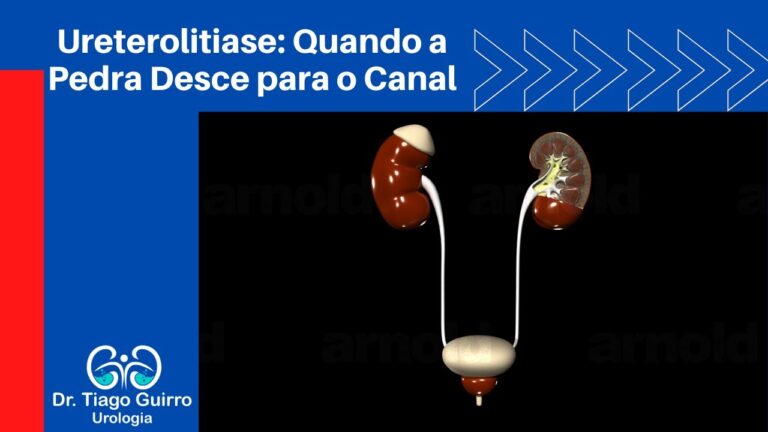 Como Expelir Pedra na Uretra Masculina
