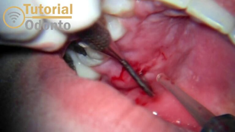 Drenagem Eficiente de Abscesso Dental