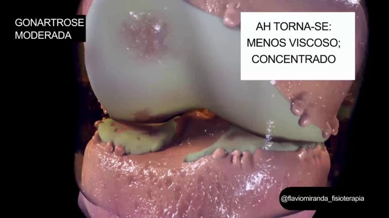 Tratamento e Gestão da Artrose Femorotibial Medial