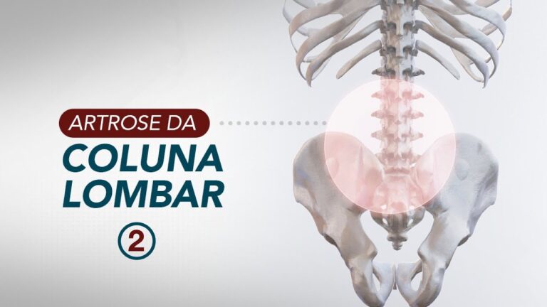 Tratamento Eficaz da Artrose na Coluna