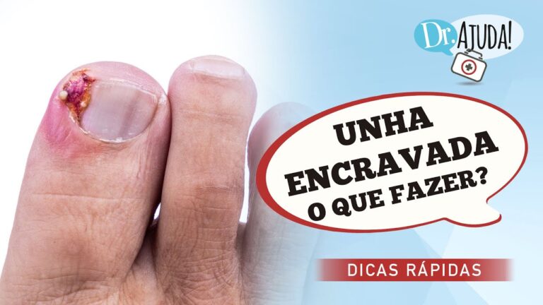 Custo para Tratar Unha Encravada: O que Você Precisa Saber