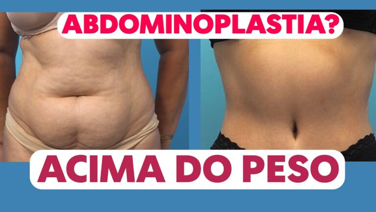 Transformações da Abdominoplastia em Pacientes Acima do Peso: Antes e Depois