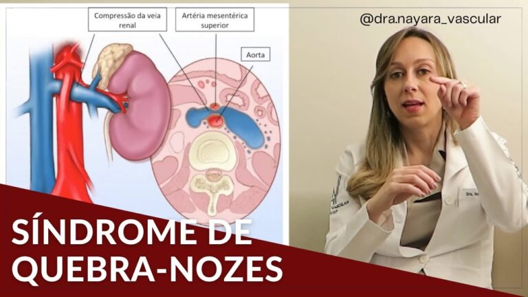 A Gravidade do S&iacute;ndrome Quebra-Nozes