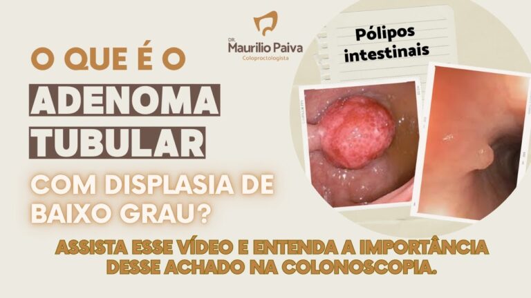 Análise de Fragmentos Irregulares com Medida de 0,4 cm no Maior Eixo