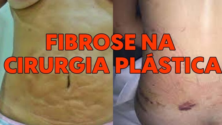 Fibrose em Cicatriz: Causas e Tratamentos Eficazes