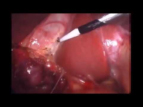 Entendendo a Colecistectomia: O Que É e Suas Implicações