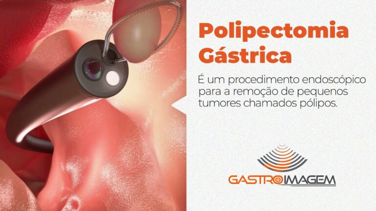 Polipos na Endoscopia: Detec&ccedil;&atilde;o e Tratamento Eficaz