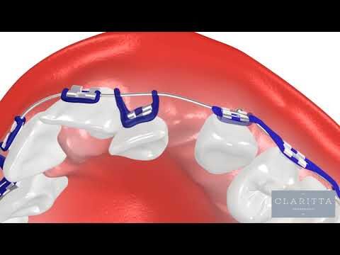 Tudo sobre Aparelho Ortodontico: O Que É e Como Funciona