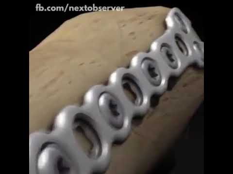 Custo da Cirurgia de Tornozelo com Placa e Pino