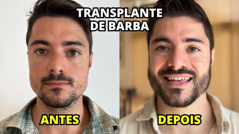 Custos do Transplante de Barba: O Que Esperar
