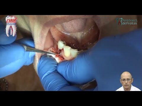 Consequências do Dente Cariado Quebrado e Como Tratar