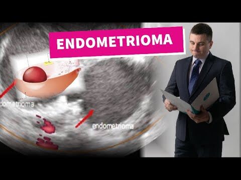 Endometrioma: Causas e Crescimento Acelerado