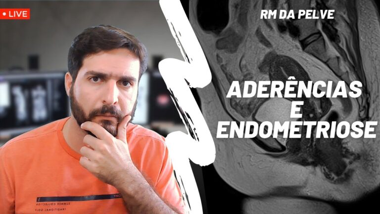 Ader&ecirc;ncia e Endometriose: Entendendo a Conex&atilde;o