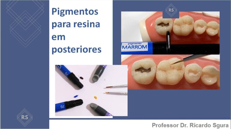 Causas e Soluções para Pigmentação nos Dentes