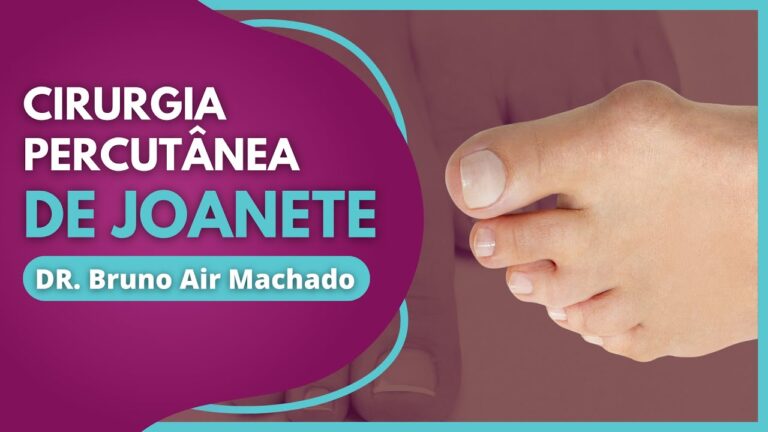 Cirurgia Percutânea de Joanete: Benefícios e Vantagens