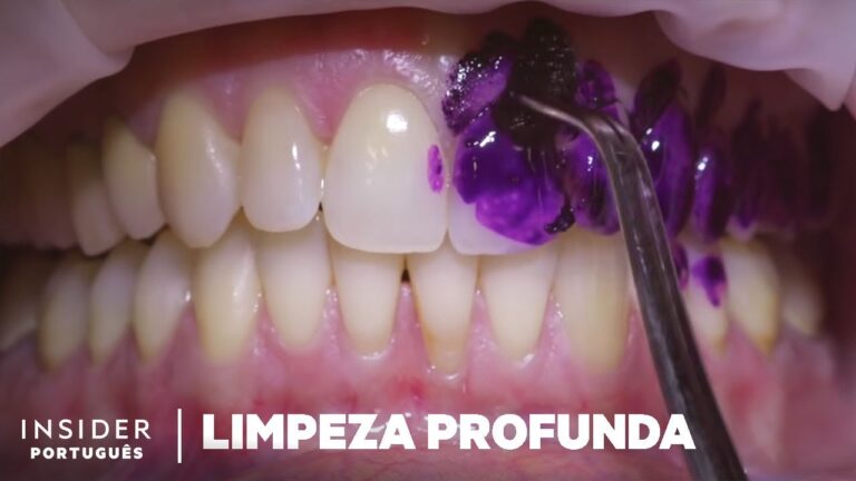 Transformação Visível: Resultados da Raspagem de Limpeza Dental Antes e Depois