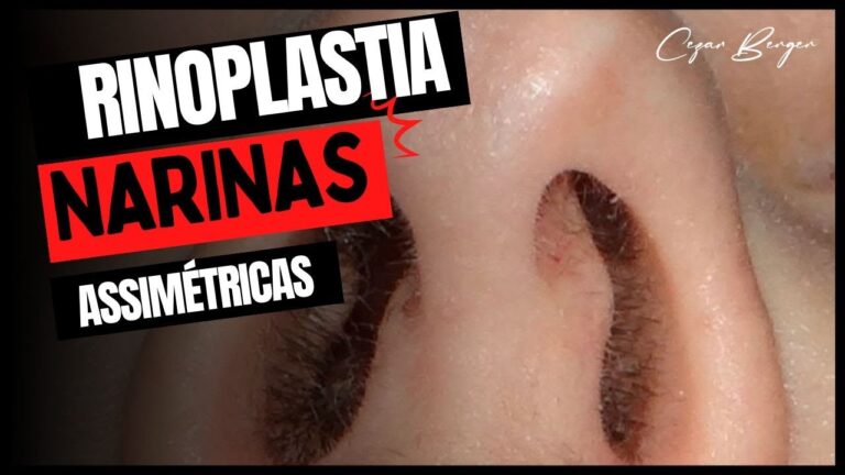 Transforma&ccedil;&otilde;es nas Narinas Ap&oacute;s Rinoplastia