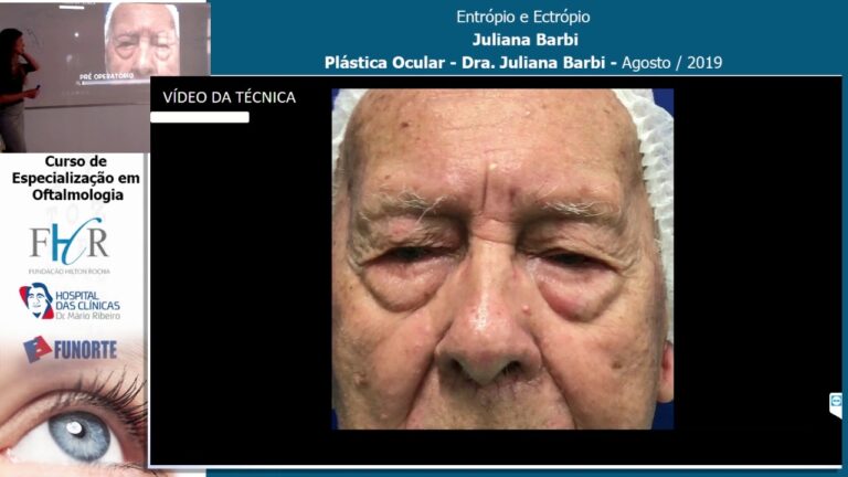 Entropia Ocular: Causas, Sintomas e Tratamentos Eficazes