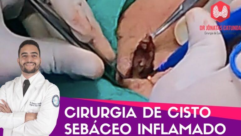 Tempo de Cicatrização de Cirurgia de Cisto Sebáceo