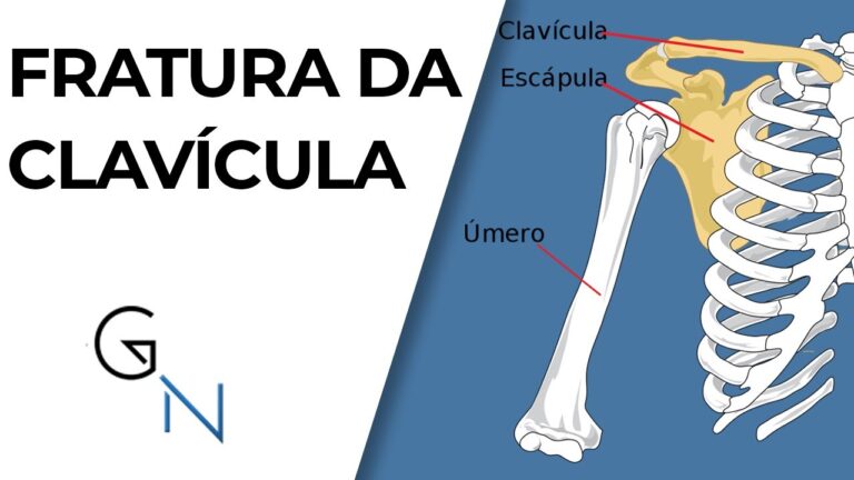 Custos da Cirurgia de Clavícula: O Que Você Precisa Saber