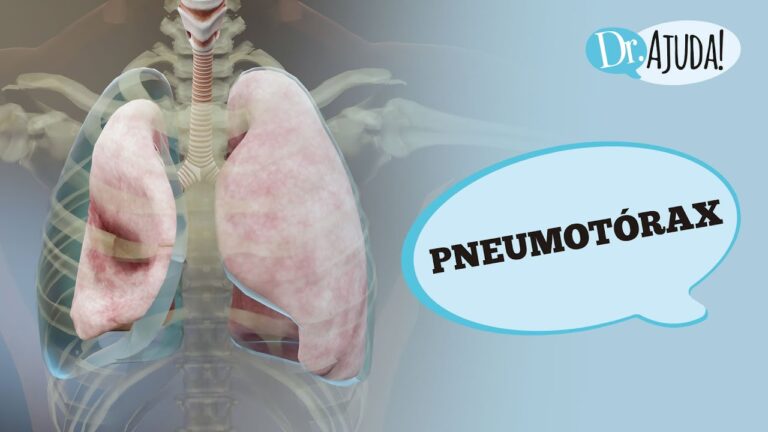 Recuperação Eficiente Após Cirurgia de Pneumotórax