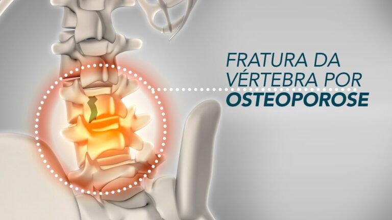Osteoporose na Coluna: Entenda os Riscos e Tratamentos