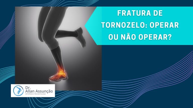 Fratura no Tornozelo: Quando a Cirurgia é Necessária?