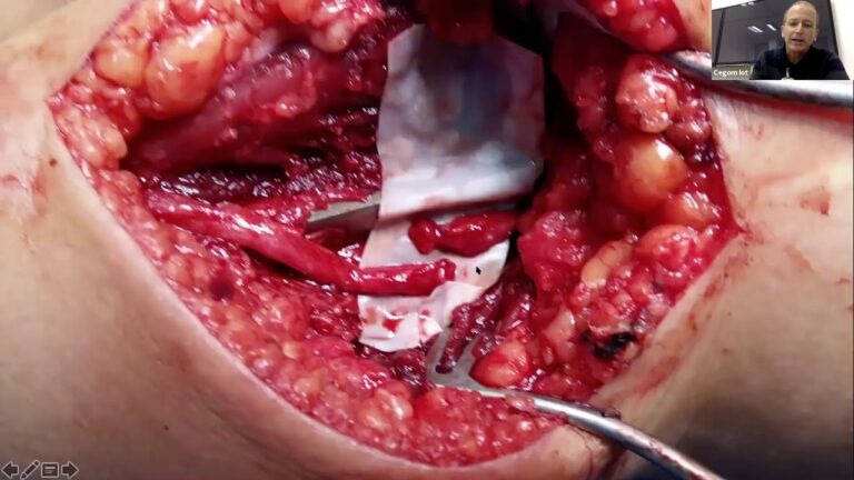 Custo da Cirurgia de Úmero com Placa: O Que Você Precisa Saber