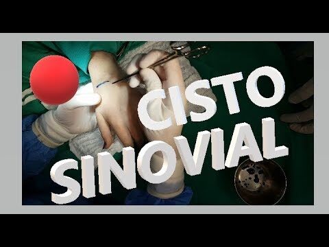 Cirurgia para Cisto na Mão: O Que Você Precisa Saber