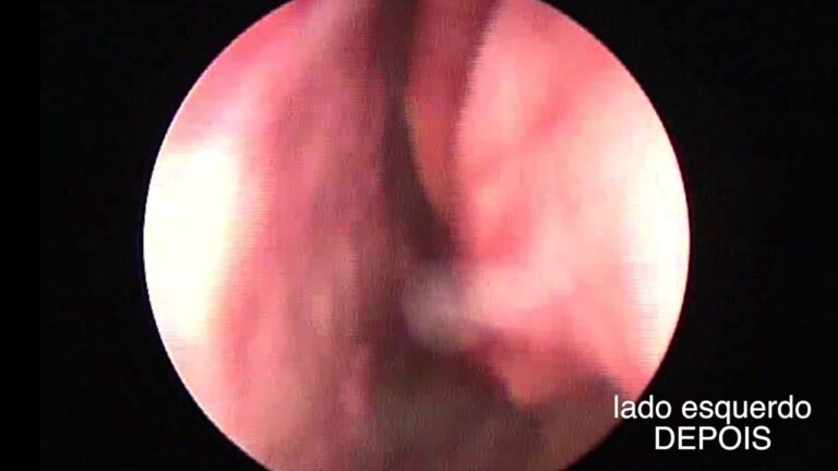 Resultados da Septoplastia: Antes e Depois