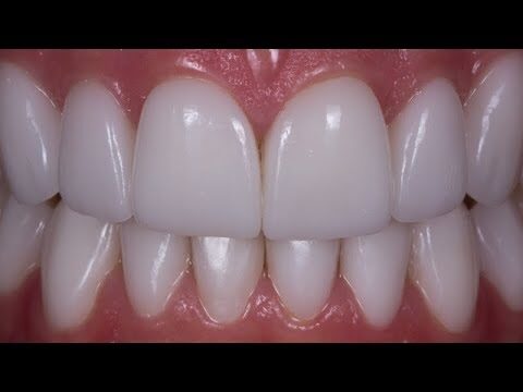 Tempo Necessário para Instalação de Próteses Dentárias Removíveis