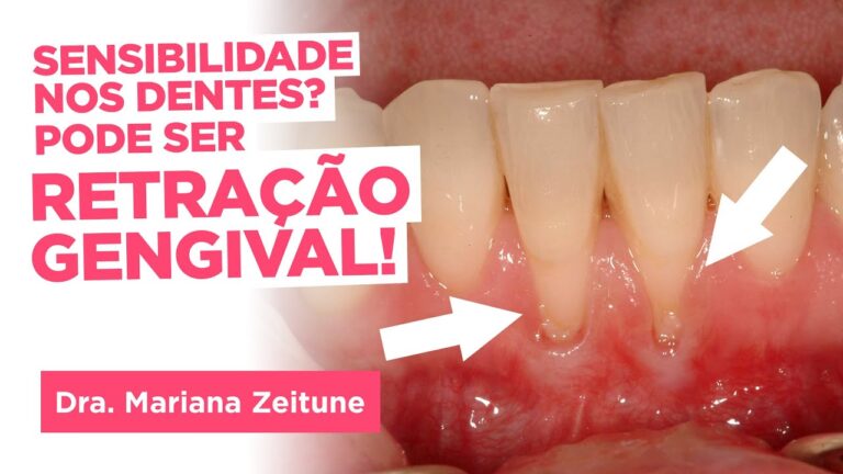 Causas e Prevenção do Desgaste da Gengiva