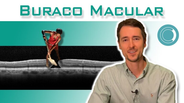 Buraco Macular: Entenda a Gravidade e Tratamento
