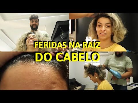 Como Tratar Feridinha no Couro Cabeludo de Forma Eficaz