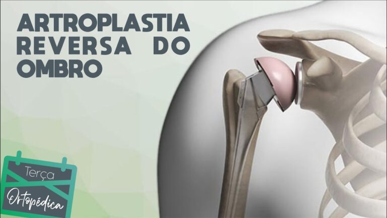 Preço da Prótese Reversa de Ombro: O Que Você Precisa Saber