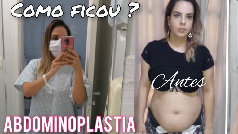 Resultados da Abdominoplastia Após 3 Meses