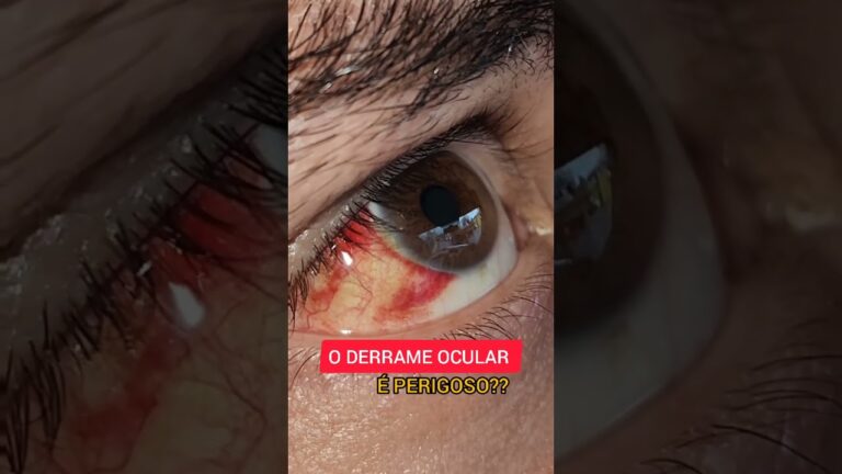 Derrame Ocular: Riscos e Cuidados Necessários