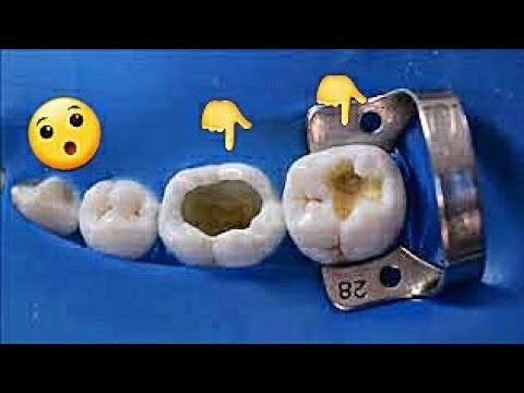 Entendendo a Obturação Dental: O Que É e Como Funciona