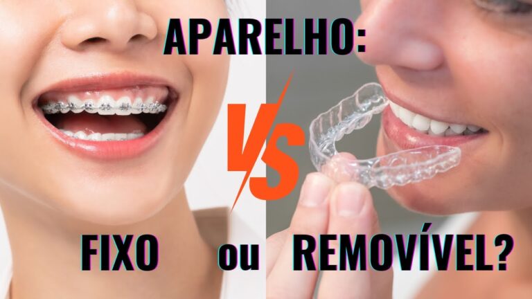 Vantagens do Aparelho Dental Removível para um Sorriso Saudável