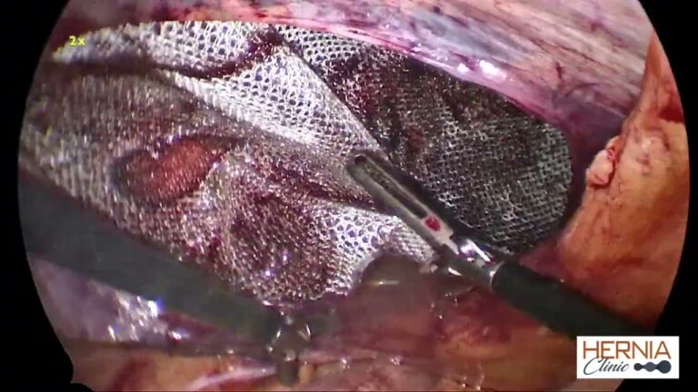 Cirurgia de Hérnia Abdominal com Tela: Benefícios e Procedimentos